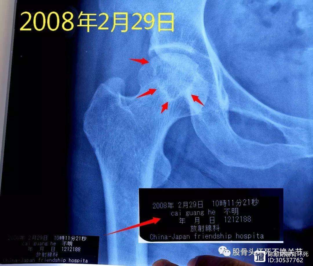 宜昌人工骨头医保报销多少(人工骨头医保报销多少比例)